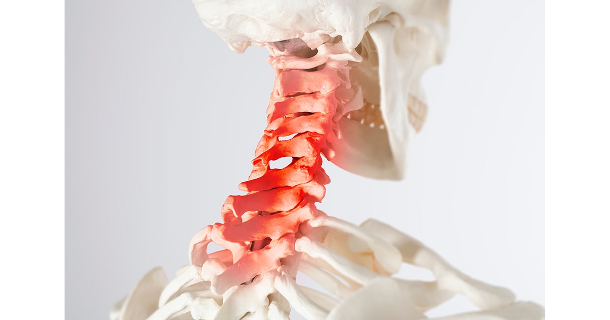 Skeletal model of the cervical spine showing vertebrae highlighted in red to illustrate the neck region affected by military neck and cervical lordosis loss