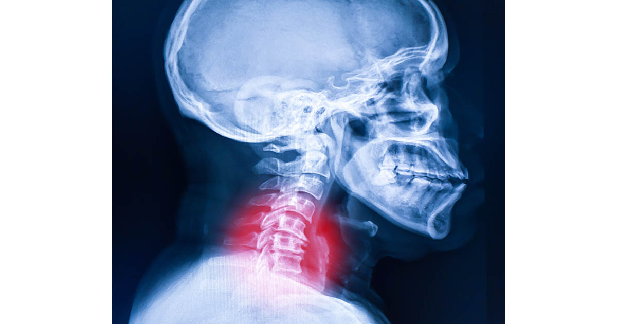 Lateral X-ray of the cervical spine with a red highlight at the lower cervical vertebrae illustrating the narrowing and nerve compression typical of cervical spinal stenosis