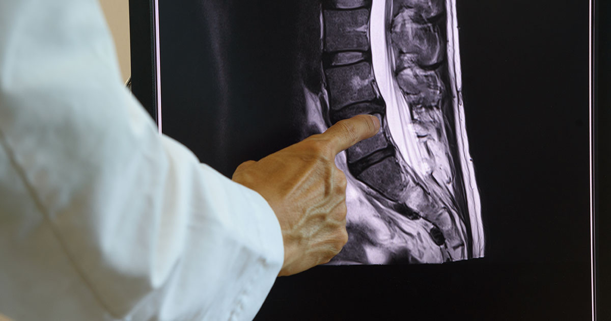 Doctor in white coat pointing at a lumbar spine MRI scan showing vertebral disc spaces and anatomy