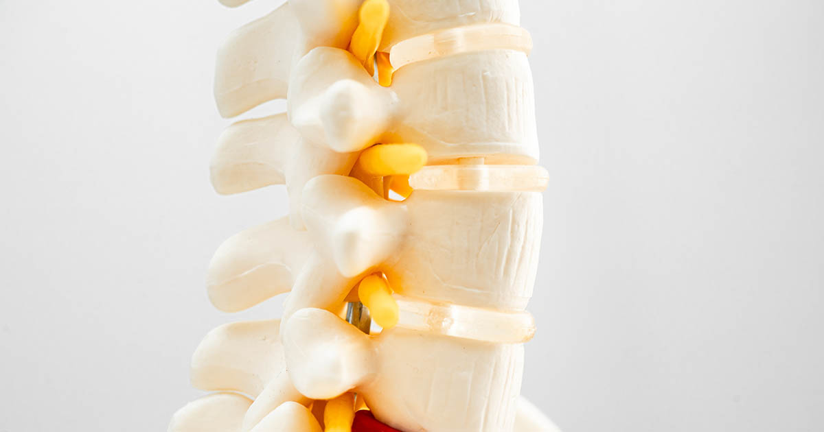 Close-up of a lumbar spine anatomical model showing the intervertebral discs and a herniated disc fragment displaced from between two vertebrae