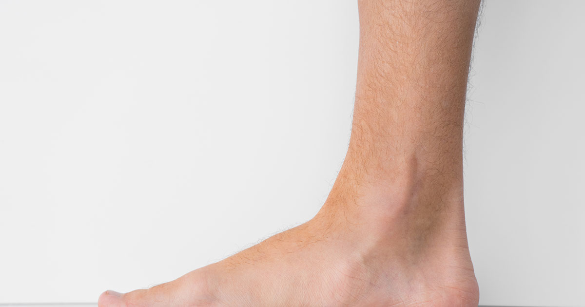 Close-up of a man's bare feet showing flat arches (pes planus) with little to no space between foot and floor, illustrating how fallen arches affect posture and lower back pain