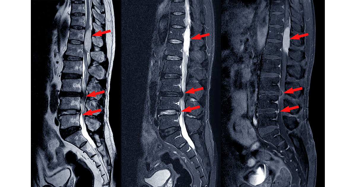 Illustrated spine anatomy showing the foraminal openings where nerve roots exit between vertebrae, with one side highlighted to show narrowing