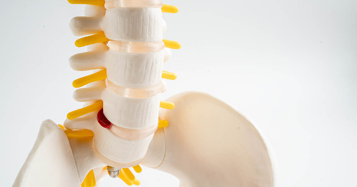 Anatomical lumbar spine model with yellow nerve roots visible alongside vertebrae and a red disc herniation marker, illustrating lumbar nerve root compression