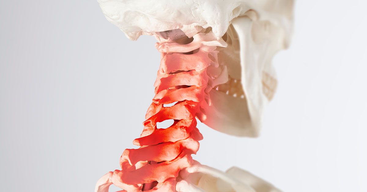 Anatomical skull and cervical spine model with upper cervical vertebrae highlighted in red, illustrating the nerve pathway involved in occipital neuralgia