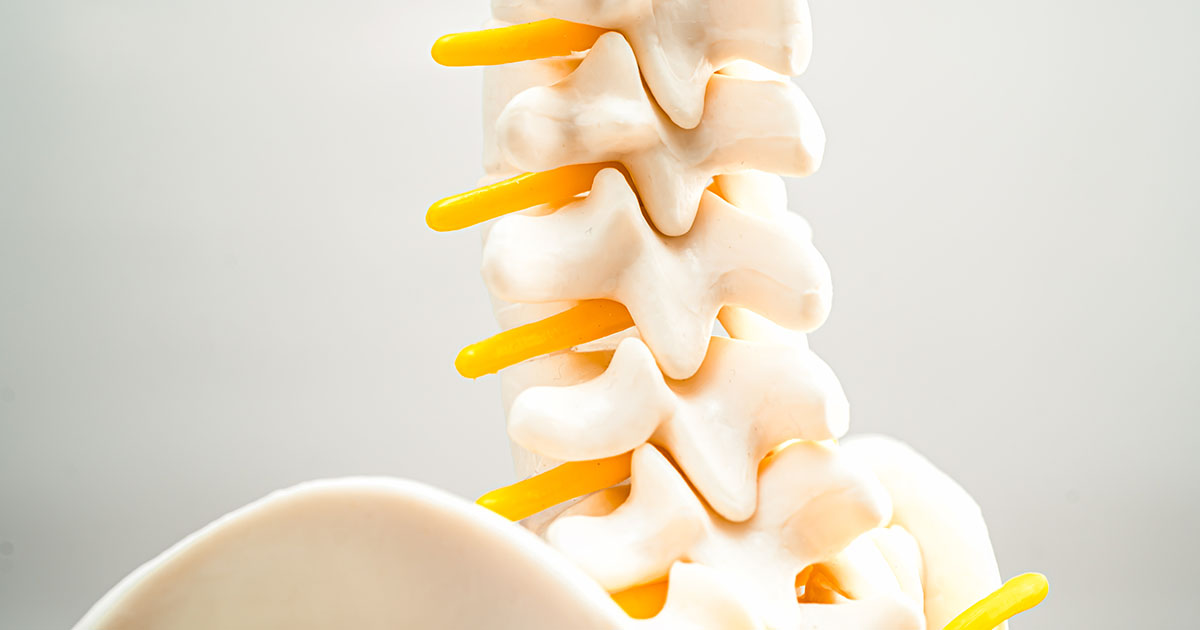 Medical illustration of a lumbar spine showing a herniated disc fragment compressing a spinal nerve root, causing one-sided leg heaviness and weakness