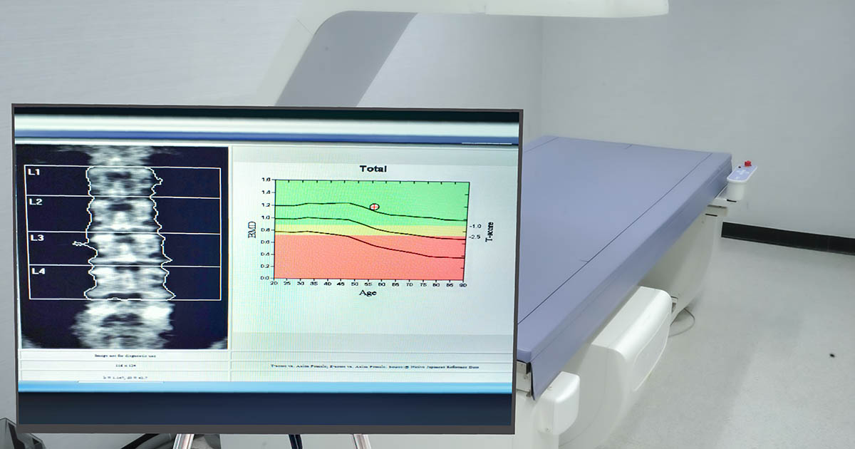 Clinical DEXA bone density monitor displaying a lumbar spine scan alongside a bone mineral density T-score chart showing age versus BMD ranges used to diagnose osteoporosis
