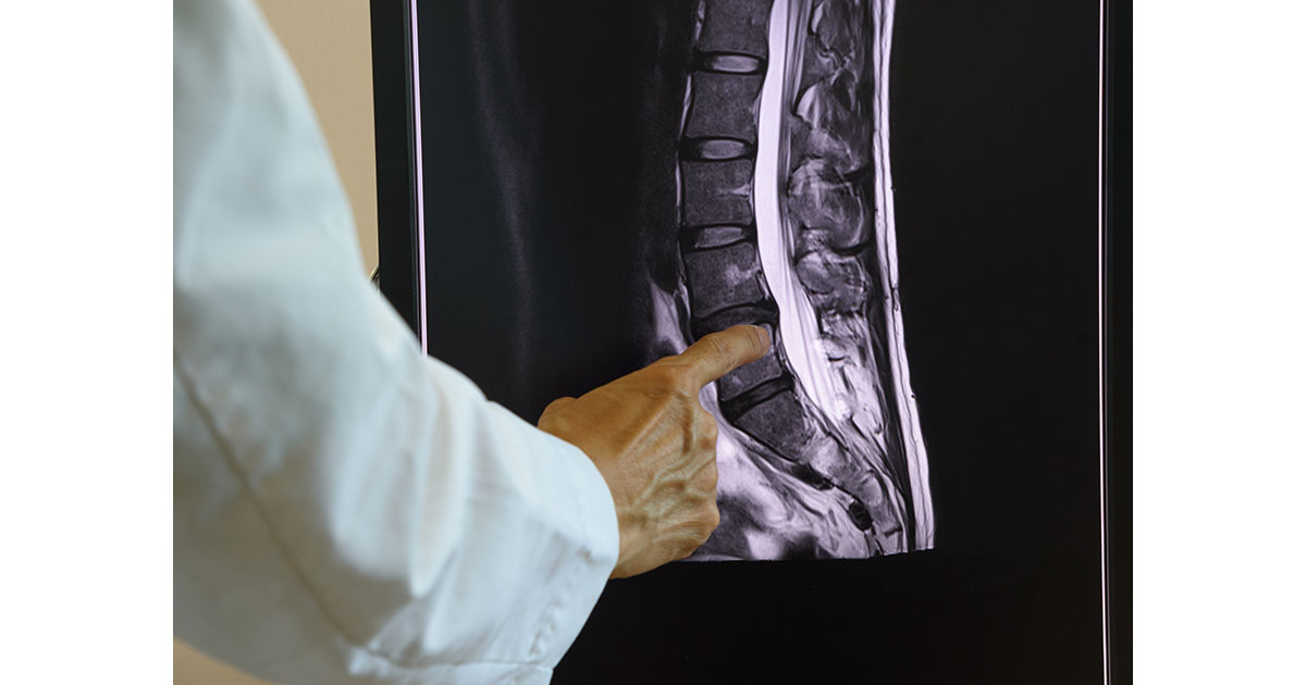Doctor reviewing a lumbar spine MRI scan to evaluate sciatica nerve compression