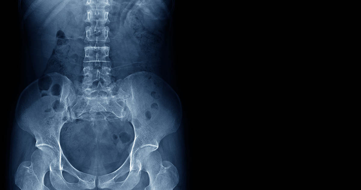 Anterior X-ray of the lumbar spine and pelvis clearly showing the lumbar vertebrae, sacrum, sacroiliac joints, and hip joint structures