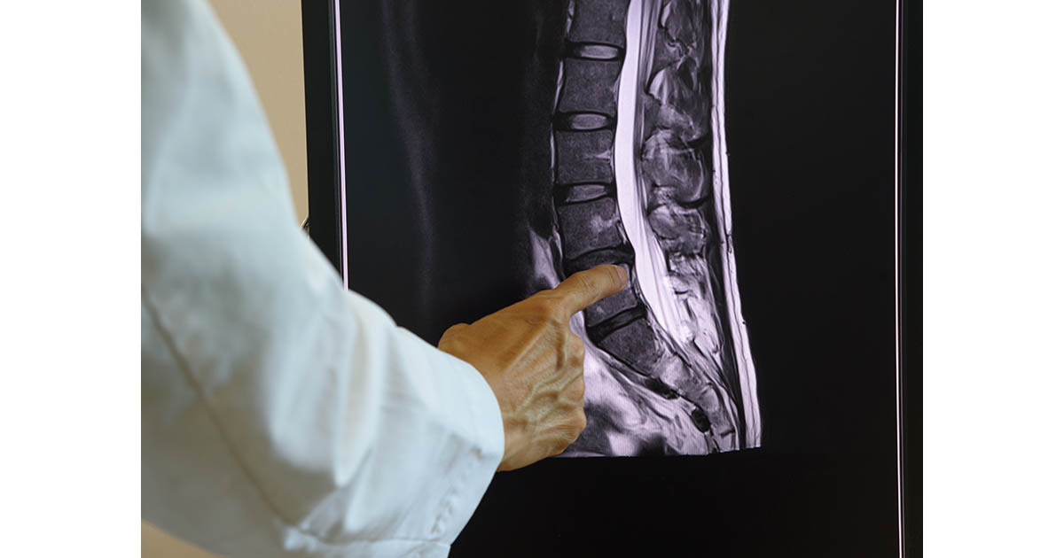Doctor in white coat pointing at a lumbar spine MRI scan on a light box, reviewing vertebral anatomy and disc levels