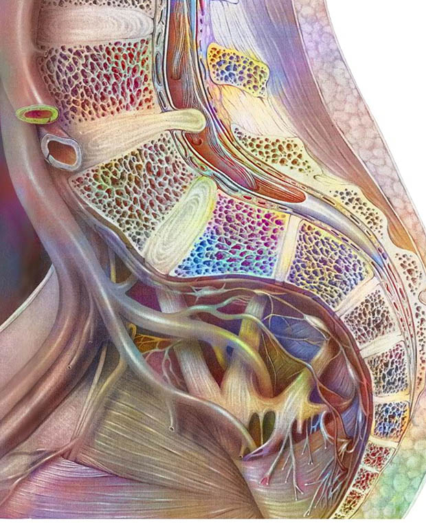 Side cross-section of the lumbar spine showing the vertebral bodies, the discs between them, a disc bulging back into the spinal canal, and the nerve roots fanning down behind the discs
