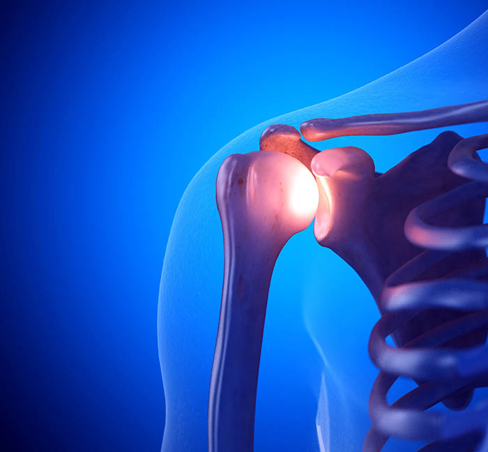 3D render of the shoulder joint highlighting the inflamed, contracted joint capsule that drives frozen shoulder