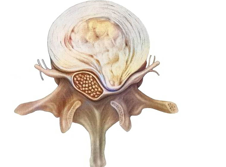 Medical cross-section of a lumbar vertebra seen from above: the intervertebral disc with its outer annulus rings and soft nucleus, the spinal canal holding the nerve bundle, and a nerve root exiting each side