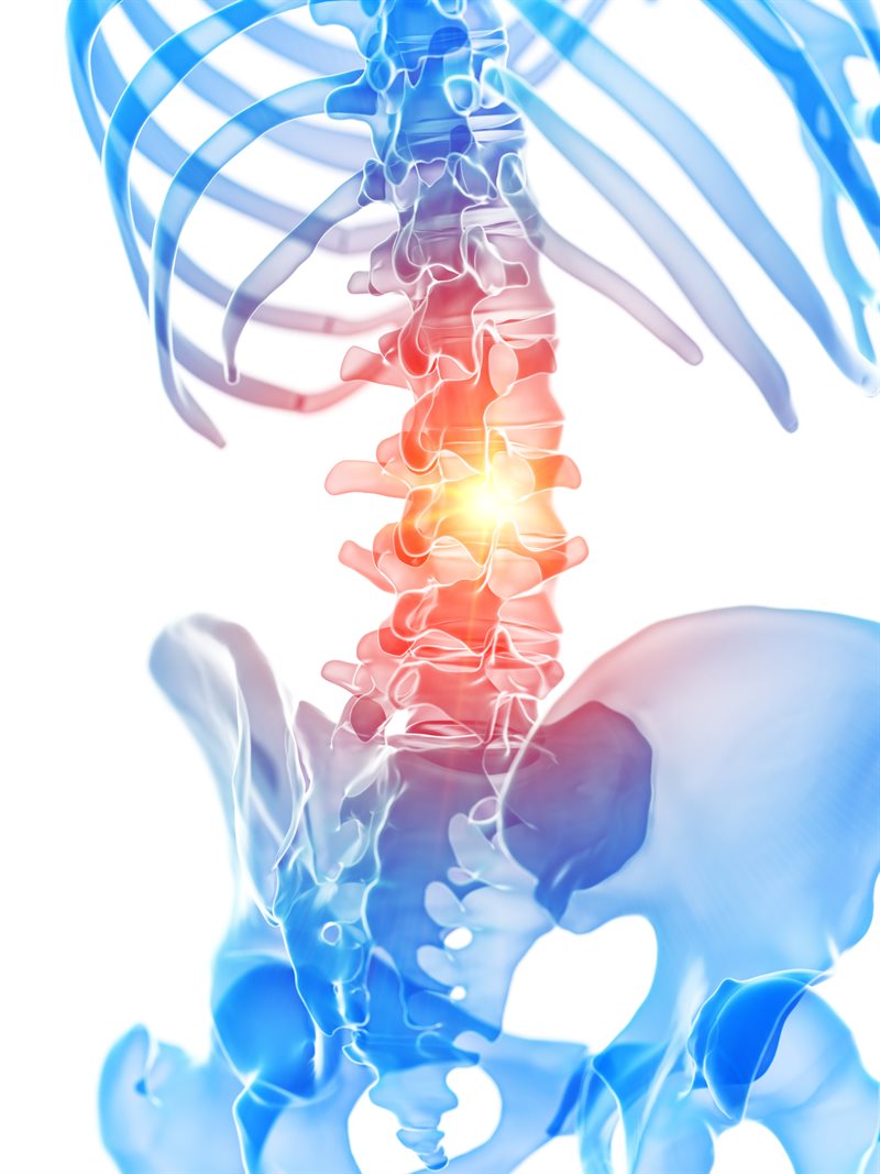 3D rendered medically accurate lumbar spine with inflammation highlighted at the L4 to L5 disc level
