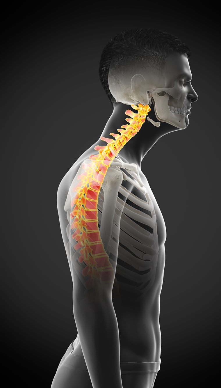 3D medical render of forward-head posture with the cervical and thoracic spine highlighted to show strain