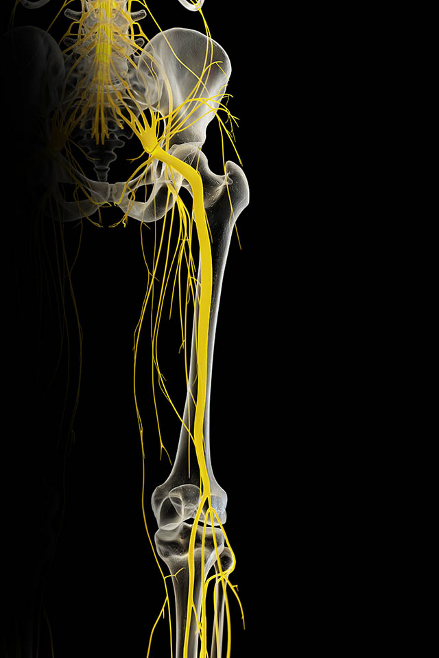 3D medical render of the sciatic nerve glowing yellow, traced from the lumbar nerve roots through the pelvis, down the back of the thigh, and branching behind the knee