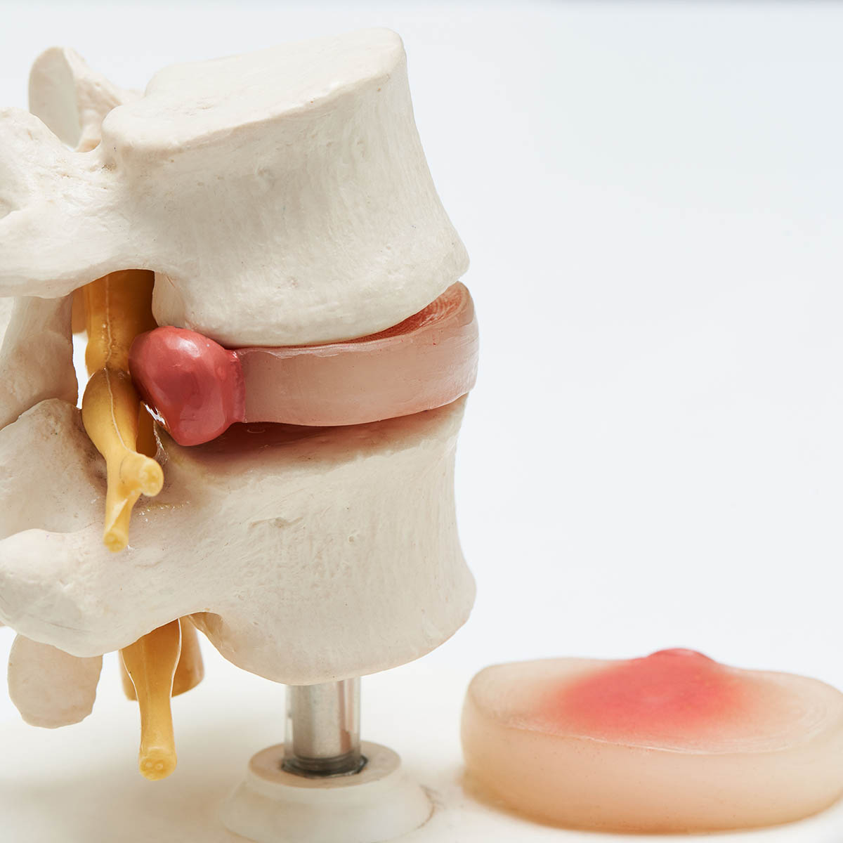 Anatomical model of a herniated lumbar disc with nerve compression, the structural problem Dr. Banman evaluates and treats non-surgically at Spine and Wellness Center Lakewood Ranch