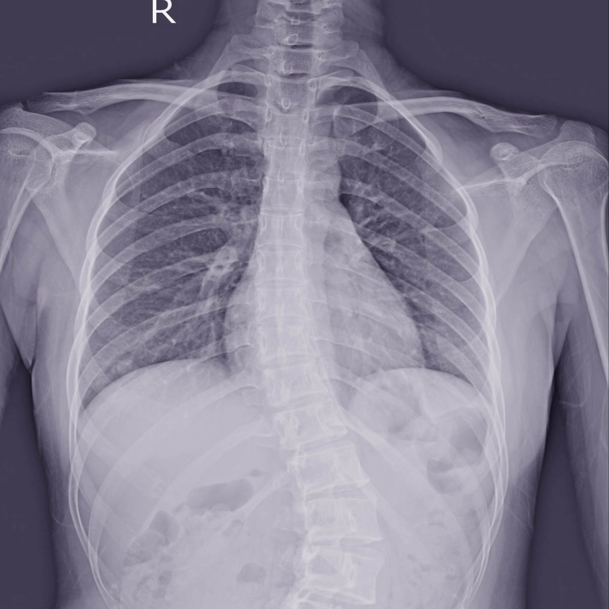 Spinal X-ray showing the curvature of adolescent scoliosis, the kind of imaging Dr. Banman uses to fit master-certified Spinal Technology braces at Spine & Wellness Center Lakewood Ranch